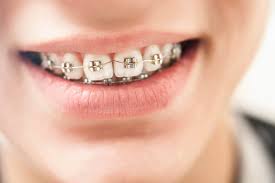 Braces atau pendakap gigi ni dipakai sebab nak betulkan gigi yang tak teratur. Tempoh Pemakaian Braces Ini Yang Patut Anda Tahu