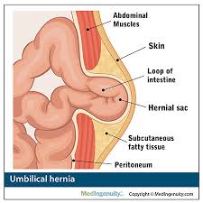 Free shipping on orders over $25 shipped by amazon. What Is A Hernia Alaska Hernia Center S Guide To Hernias Alaska Hernia Center