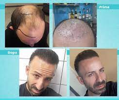 Before After Transplantation Sac Ekimi Oncesi Ve Sonrasi Prima E Dopo Sacekimi Sacekimiuzmani Sac Beard Transplant Hair Transplant Hair Transplant Results