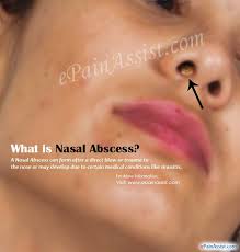 Definition, description, causes and risk factors: What Is Nasal Abscess How Is It Treated