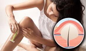 The condition is most prevalent among people who have coarse or curly hair. How To Get Rid Of Ingrown Hair Soak Your Hair Three To Five Minutes Before Shaving Express Co Uk