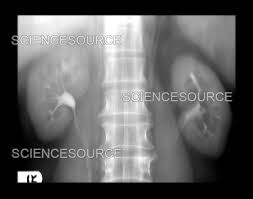 Image result for Intravenous Pyelogram