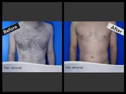 Check spelling or type a new query. Laser Tattoo Removal Price Cebu
