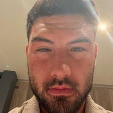 Love Island winner Liam Reardon shares shocking pictures of swollen face  after food poisoning nightmare