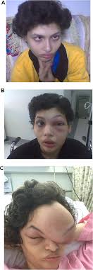 Evolution of the tumor A, photograph for the patient in 2005, no tumor...