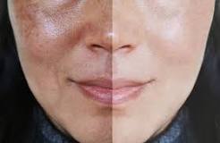 آنچه باید درباره آلفا آربوتین برای پوست خود بدانید