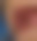 Image result for dental cancer