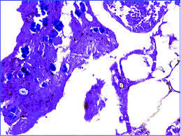 Sarcina ventriculi are gram positive bacteria which are found in water and soil and thrive in low ph as predicted in the literature this is the first case report of sarcina ventriculi in a patient with upper. Sarcina Ventriculi Overgrowth And Necrotic Debris Hematoxylin Eosin Download Scientific Diagram