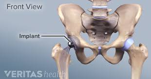 Maybe you would like to learn more about one of these? Indications And Eligibility For Total Hip Replacement Surgery