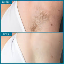 The results of having laser hair removal on my armpits, 8 yrs later. Underarm Laser Hair Removal Milan Laser In Lincoln Ne