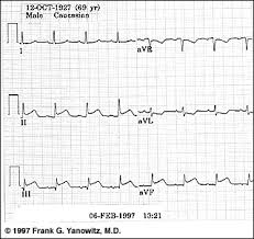 Maybe you would like to learn more about one of these? Ecg Learning Center An Introduction To Clinical Electrocardiography