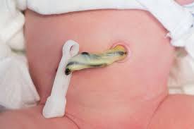 Cordon Umbilical Infectado Sintomas Causas Y Tratamiento Eres Mama