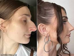 My $11,000 nose job gave me clarity to ask for a divorce