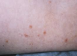 Check spelling or type a new query. Spider Mite Bites Shefalitayal