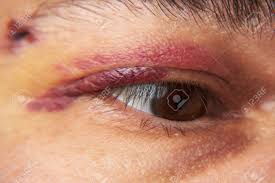 Immagini Stock - Vista Ravvicinata Di Un Livido Vicino Allocchio, Il Volto  Di Un Uomo Con Un Ematoma. Image 147442680