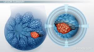 What Is A Malignant Tumor Definition Treatment Video Lesson Transcript Study Com