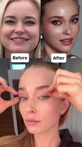 Orbicularis Oculi Muscle Before and After