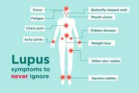 Lupus is a complex and potentially serious autoimmune condition. Lupus Signs And Symptoms How To Tell If You Could Have Lupus
