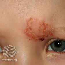 Image result for Impetigo