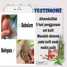 Rutin yang memerlukan anda bekerja di depan komputer, kurang tidur dan kekurangan nutrisi akan menyebabkan mata letih. Petua Kak Ida Atasi Masalah Kulit Kurap Posts Facebook
