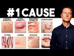 Image result for contact dermatitis