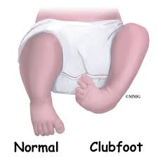 Club foot can come back if treatment is not followed exactly, meaning parts of the process may need to be repeated. Clubfoot Eorthopod Com