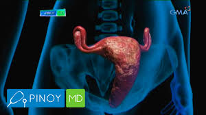 This is a procedure which allows a more detailed examination of the cervix. Pinoy Md How To Detect Cervical Cancer Youtube