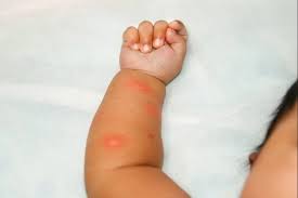16 cara menghilangkan belang di kaki yang sudah lama dan baru akibat matahari, bekas luka atau penyakit dengan bahan alami dan cepat. 5 Cara Menghilangkan Bekas Gigitan Nyamuk Pada Bayi