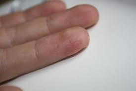 Gaaanz Trockene Haut An Meinen Handen Finger Rissige Haut