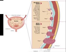 Image result for Bladder Cancer Staging