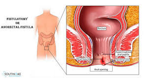 Fistulas may develop between different organs, such as between the esophagus and the windpipe or the bowel and the vagina. Fistulotomy Anal Surgery Cause Diagnosis Treatment Of Anal Fistula