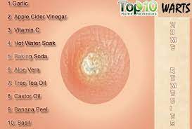 7 Home Remedies For Warts Lemon Tea Tree Oil Duct Tape Etc Home Remedies For Warts Warts Remedy Remedies