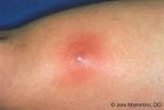 Ingrown Hair Boils