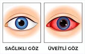 Uveit Nedir Belirtileri Nelerdir
