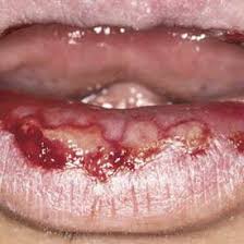 Image result for Erythema Multiforme Major