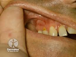 Image result for syphilis ulcer