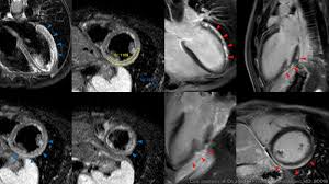In serious cases, the signs and symptoms of myocarditis vary, depending on the cause of the disease. Ut7jvxpvb6tmm