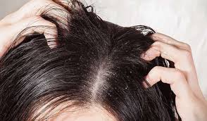 What Does It Mean When You Dream About Lice 2020 In 2020 Dandruff Remedy Home Remedies For Dandruff Getting Rid Of Dandruff