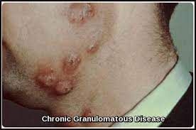 Chronic Granulomatous Disease - Ask Hematologist | Understand ...