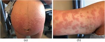 Image result for pruritic urticarial papules and plaques of pregnancy