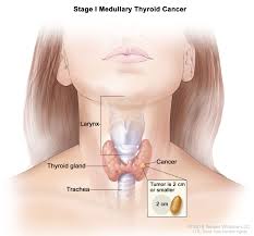 She had been treated for renal cell carcinoma with radical nephrectomy and chemotherapy with pazopanib (votrient ®) and everolimus (afinitor ®) antiangiogenic agents.there was no history of radiation therapy, obvious metastatic disease or surgical treatment. Head And Neck Cancers Treatment Unm Cancer Center