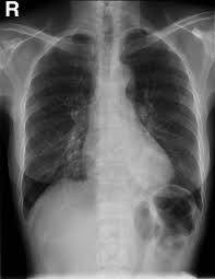 Many doctors are increasingly looking to ultrasound scans. Lung Metastases From Breast Cancer Radiology Case Radiopaedia Org