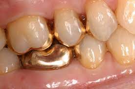 Inlays And Onlays Are Made In A Dental Lab From Composite Resin Material And Attached To The Teeth With Adhesive Cosmetic Dentistry Dental Lab Laser Dentistry