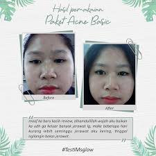 Aplikasikan ms glow for men power serum pada wajah yang telah dibersihkan pada pagi dan malam hari agar mendapatkan kulit wajah yang sehat, lembab, bersih, cerah dan bebas dari jerawat. Skincare Untuk Kulit Berjerawat Ms Glow Solusinya