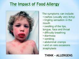 Learn about the different types of food allergies and how to manage them. Think Allergens All Staff Training On Eu Regulations Inc Ward Nursing Staff Involved In Food Service Ppt Download
