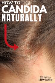 Scalp yeast infection and hair loss if your scalp yeast. Pin On Work Stuff