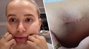 If you aren't sure which type of skin cancer. Molly Mae Hague Details Terrifying Skin Cancer Ordeal Which Saw Mole Removed From Leg Capital