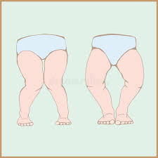 Image result for Genu Varum