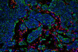 The cancer cells that have spread to the brain are breast cancer cells. New Study Reveals Why Breast Cancer Spreads To The Brain