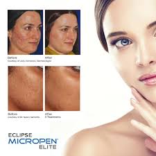We did not find results for: Micro Needling Goldberg Medical Spa
